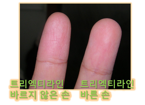 스킨트리 이미지