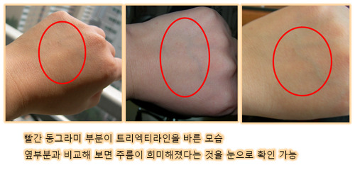 스킨트리 이미지
